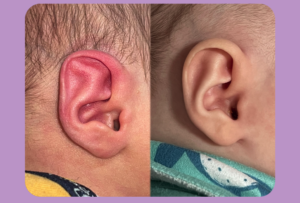 antes e depois orelha pontuda ou orelha de stahl