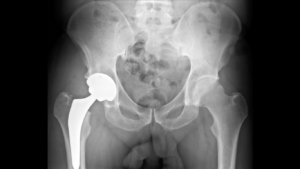Radiografia de artroplastia de quadril com prótese total implantada